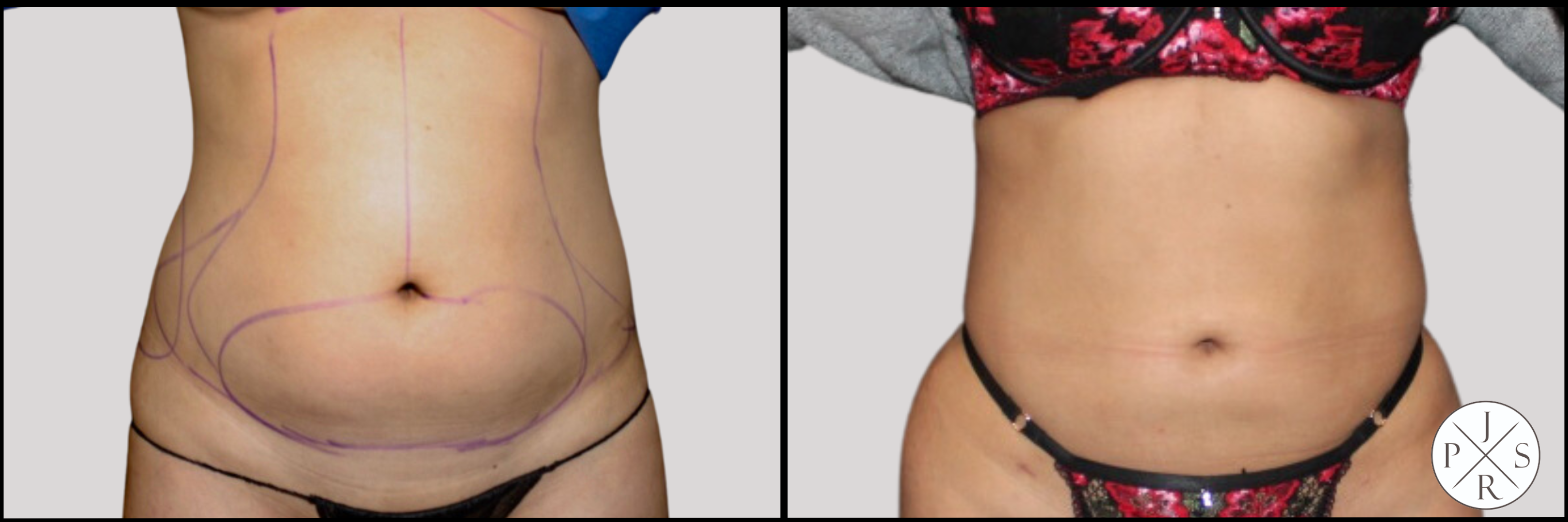 Liposuction Before & After Image